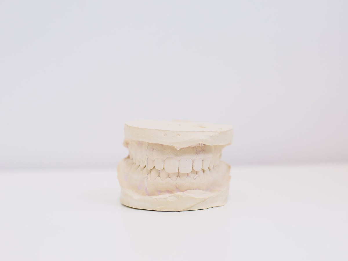 Plaster cast of the upper and lower jaws used to make a custom night guard
