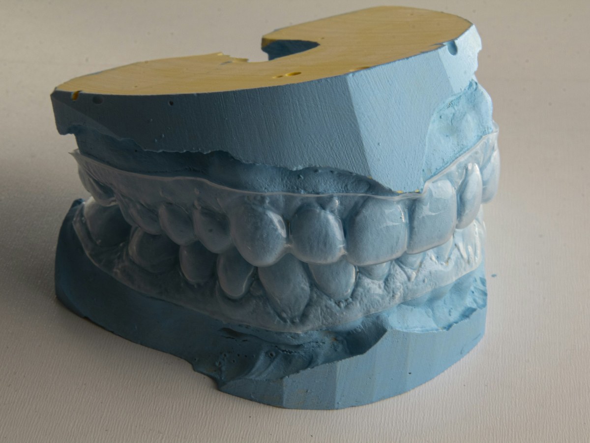 Clear custom tray fitted over a blue stone dental model
