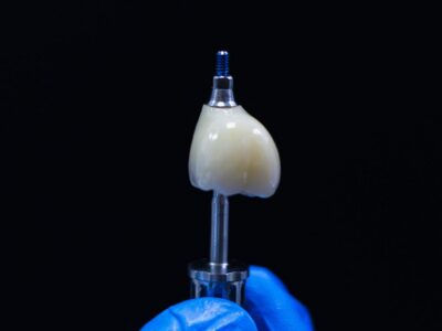 Gloved hand holding a dental implant with a crown attached