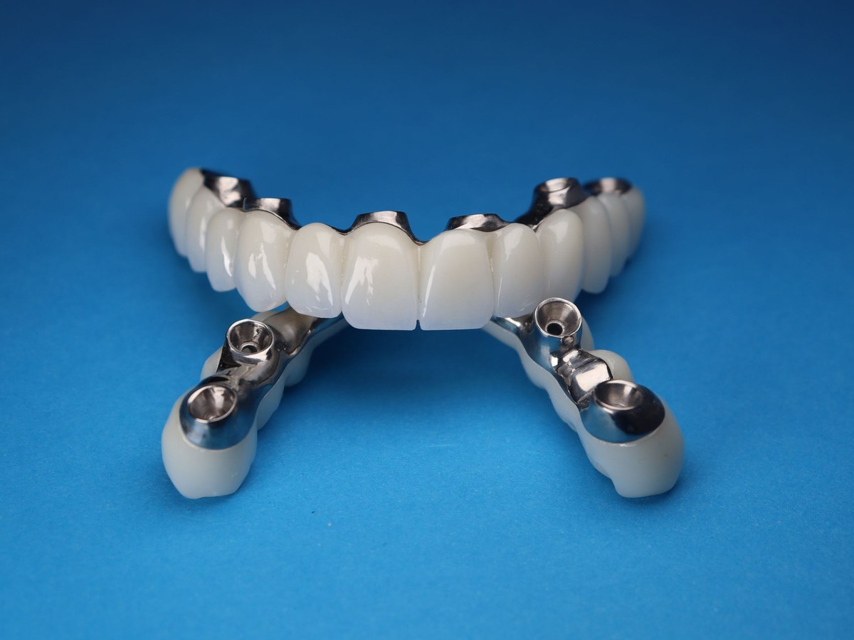 Full-arch implant bridge with metal connectors on a blue background