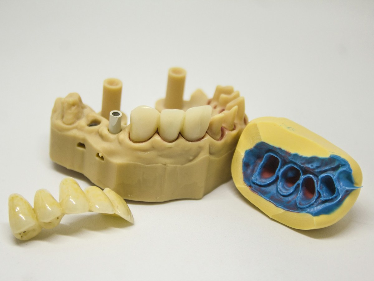 Stone dental model with implant posts beside a bridge and an impression