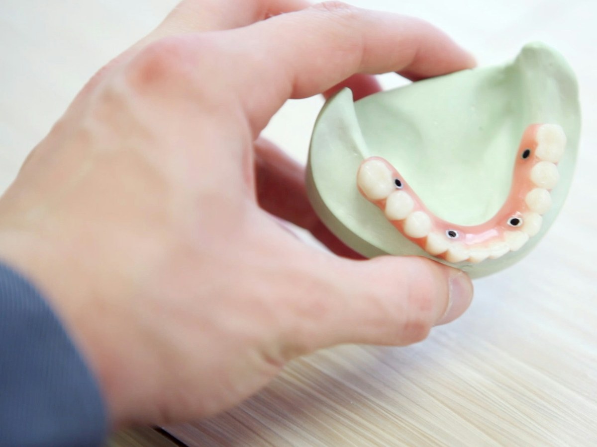 Hand holding a dental model of an implant-supported denture