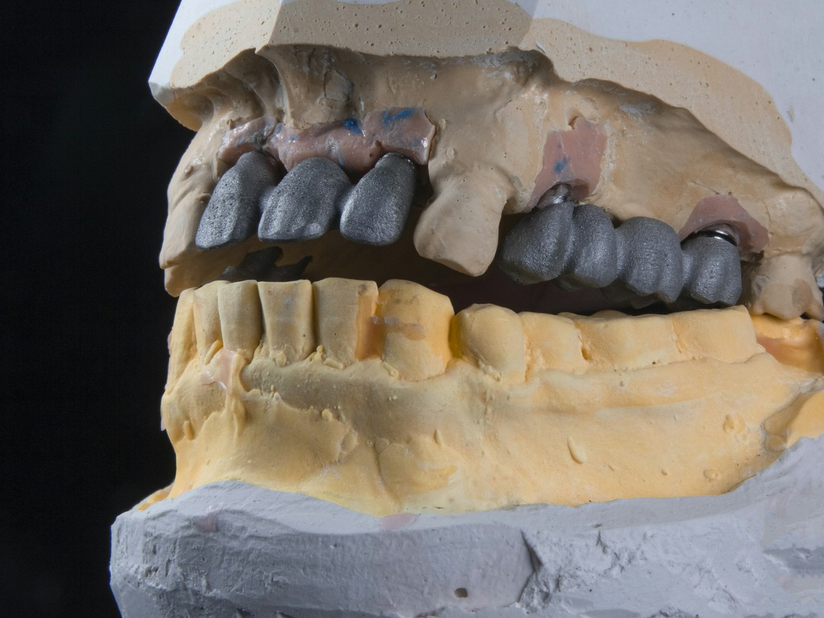 Metal crown frameworks on a plaster dental model