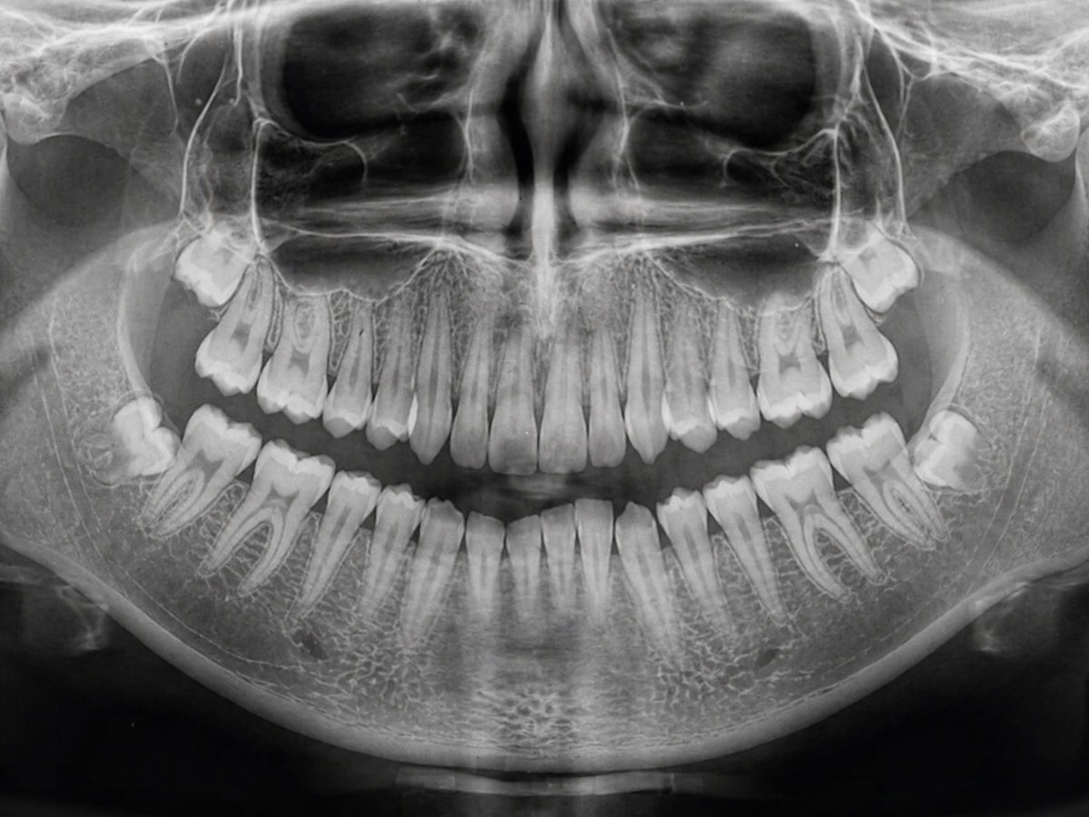 Panoramic dental X-ray showing a full set of teeth including wisdom teeth