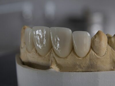 Porcelain veneers fitted on a stone model of the front teeth