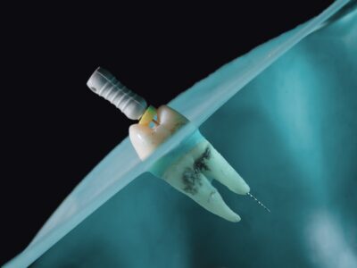 Molar with a root canal file passing through the crown into the root