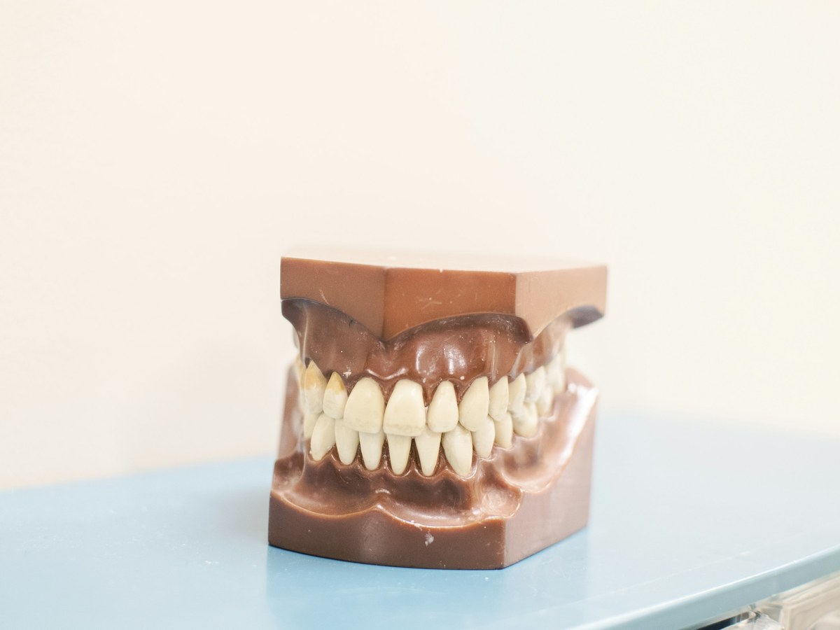 Dental model showing how the upper and lower teeth meet in a bite